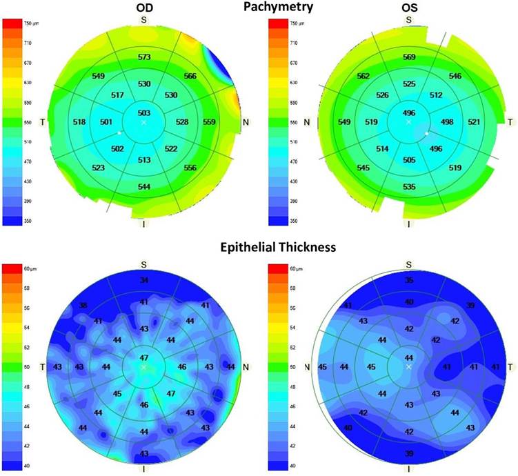 Frontiers | Assessment of corneal epithelial thickness mapping by spectral-domain optical coherence tomography