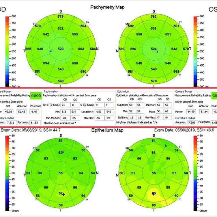 Case 1: A patient with normal cornea topography on Pentacam HR... | Download Scientific Diagram