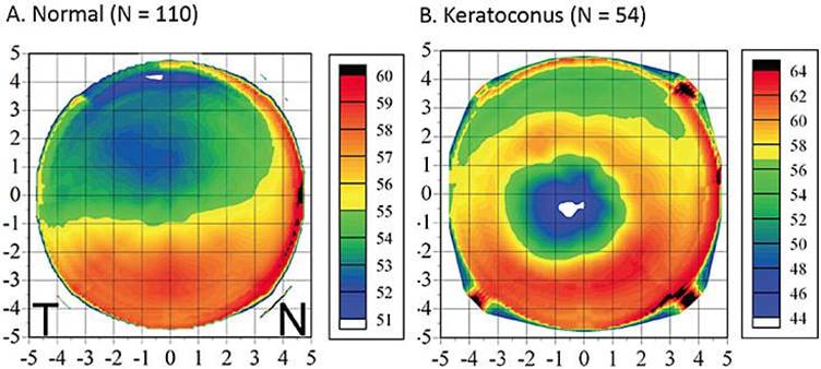 Deciphering Epithelial Mapping for Refractive Surgery | Corneal Physician