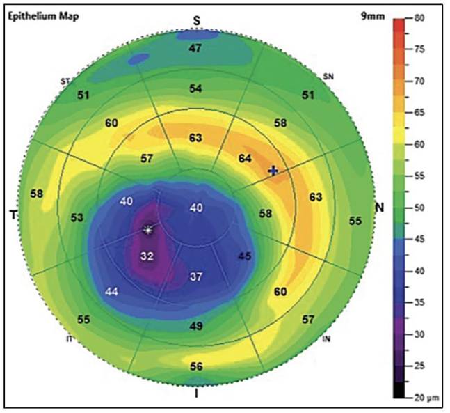 Decoding The Keratoconus Matrix
