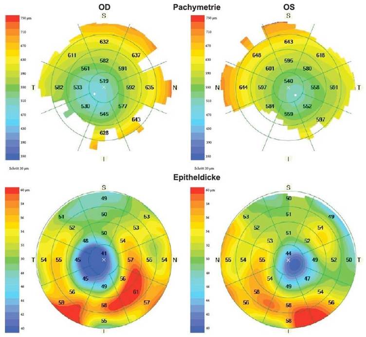 Combined OCT, Tomography Detects Keratoconus in Adolescents Better